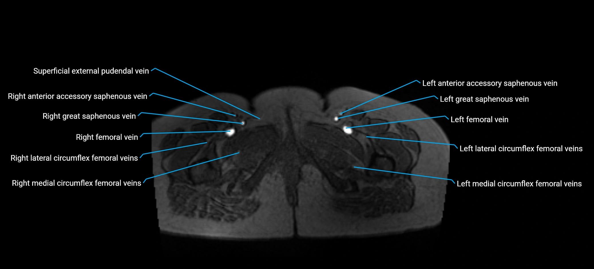 MRV abdomen pelvis & lower limb axial cross sectional anatomy labelled MRI image 203 (1).webp